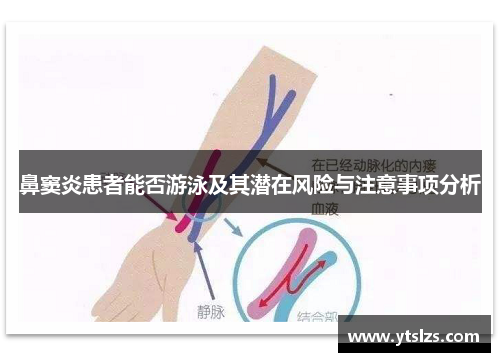 鼻窦炎患者能否游泳及其潜在风险与注意事项分析